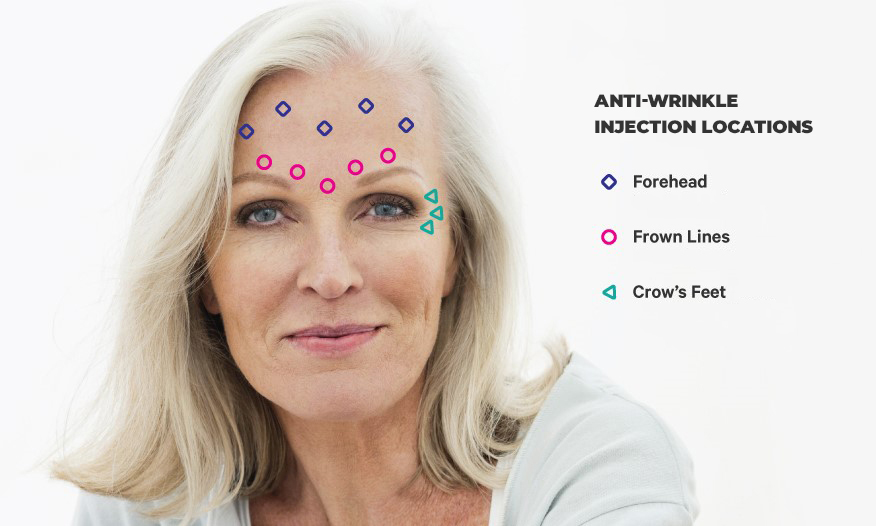 5 Uses For Anti Wrinkle Injections That Might Surprise You Dr Rory Dower